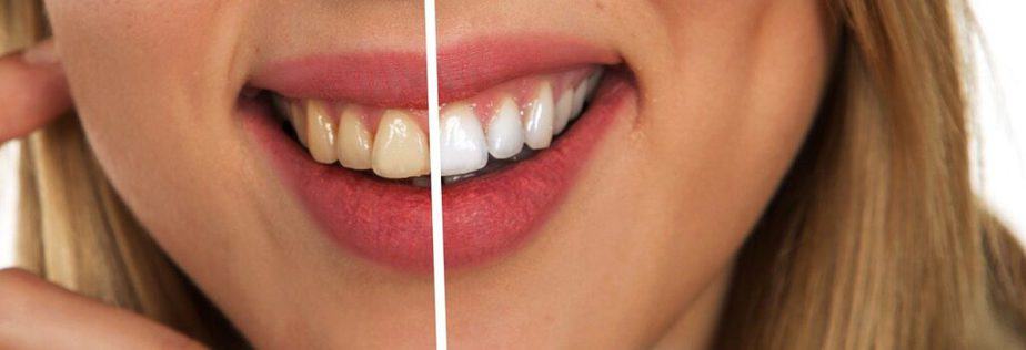 How to naturally whiten teeth at home: Home Remedies